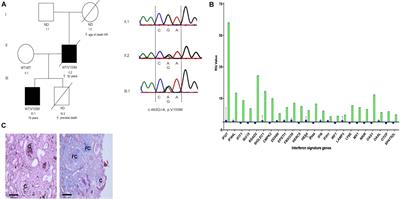 Adult-Onset ANCA-Associated Vasculitis in SAVI: Extension of the Phenotypic Spectrum, Case Report and Review of the Literature